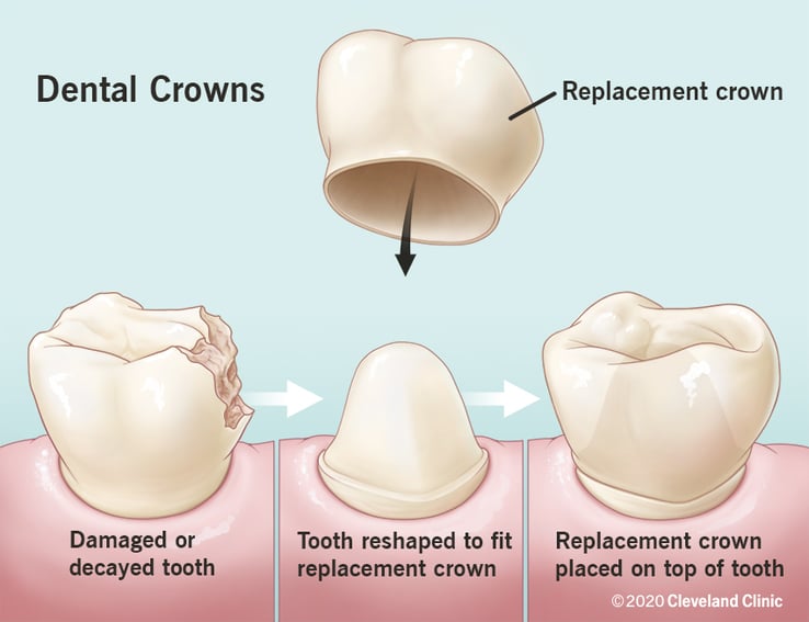 Avoiding Dentist Scams and the 11 Unnecessary Dental Procedures